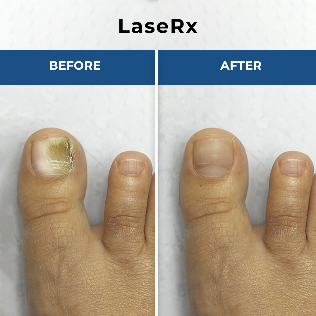 LaseRx - Nail Fungus Remover Device