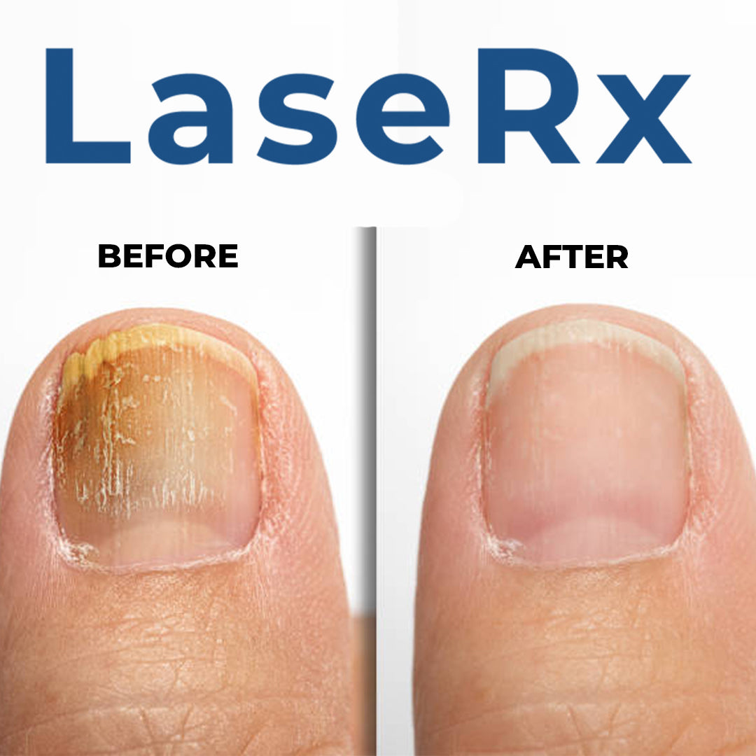 LaseRx - Nail Fungus Remover Device